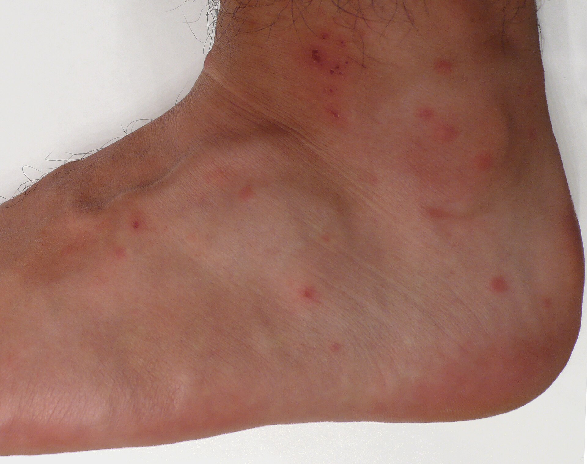 Chigger (Trombicula)